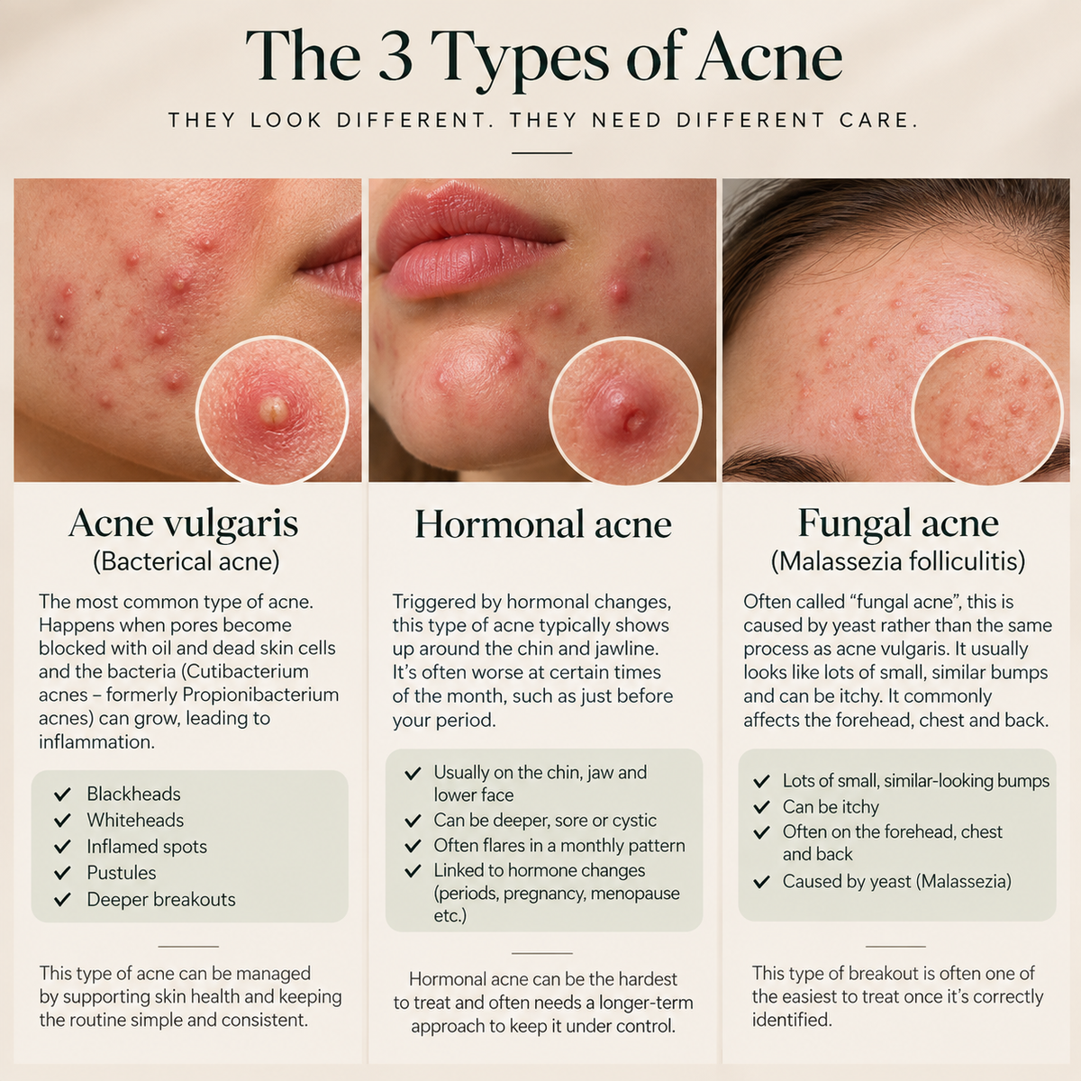 Acne & Breakouts