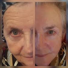 Side-by-side comparison of a person's face before and after a treatment.