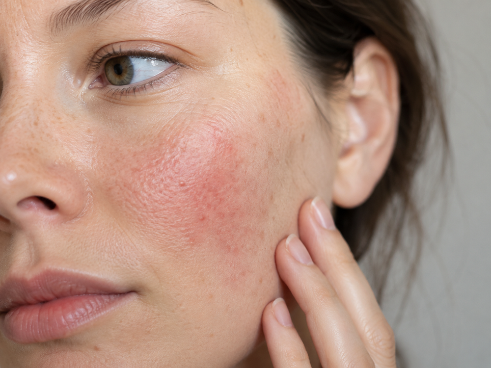 Close-up of a woman's face showing red, dry, and flaky skin on her cheek, with her hand touching her face.