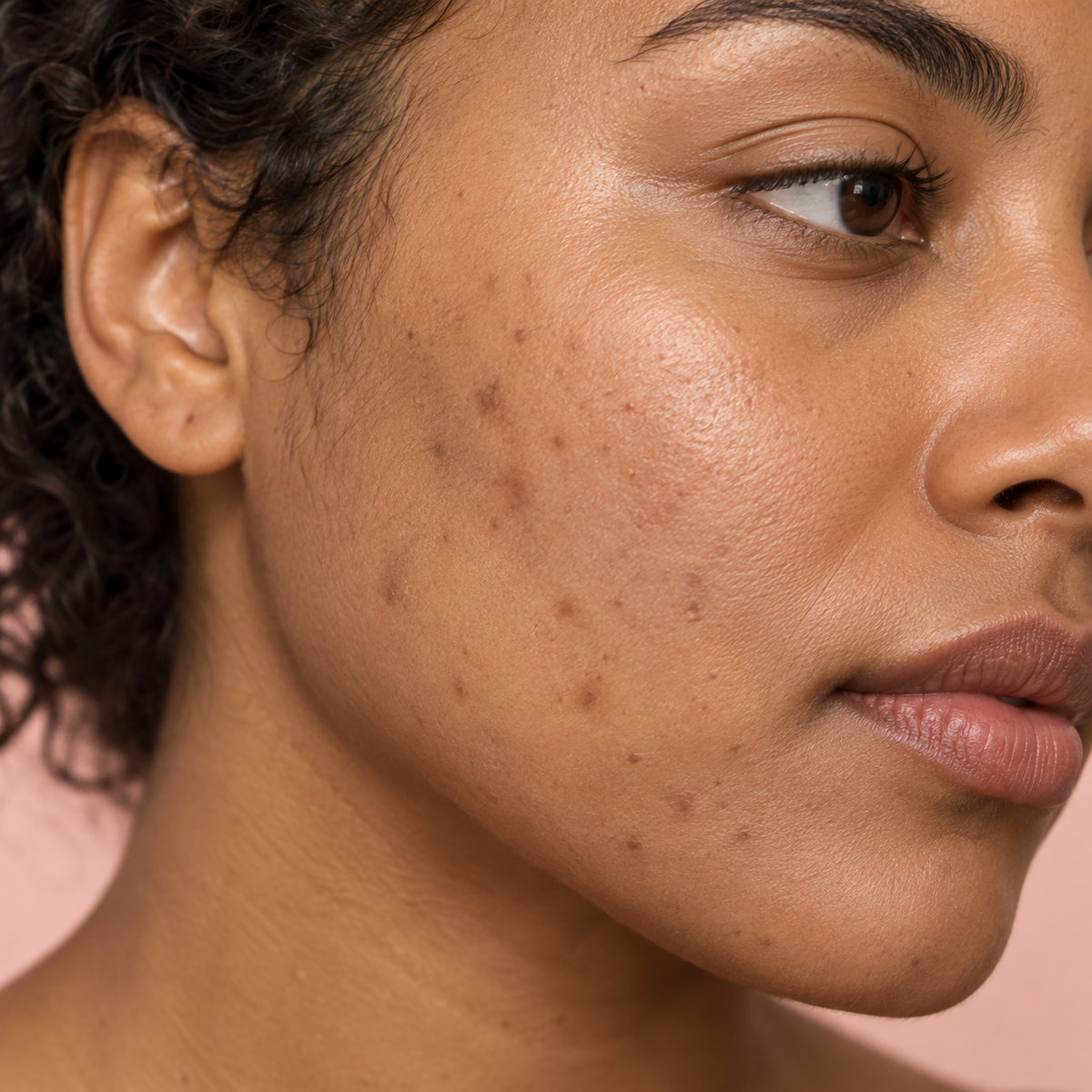 Close-up of a woman's face showing skin texture, blemishes, and acne on her cheek, with a soft pink background.